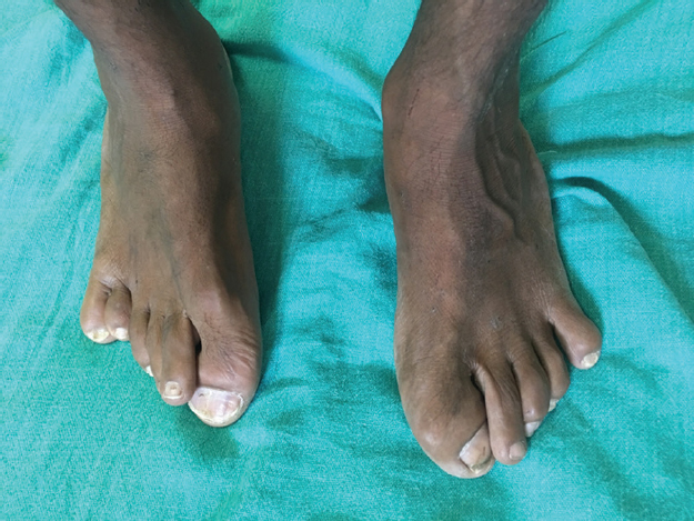 Polydactyly, an extra toe on the right foot.